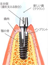 インプラント01